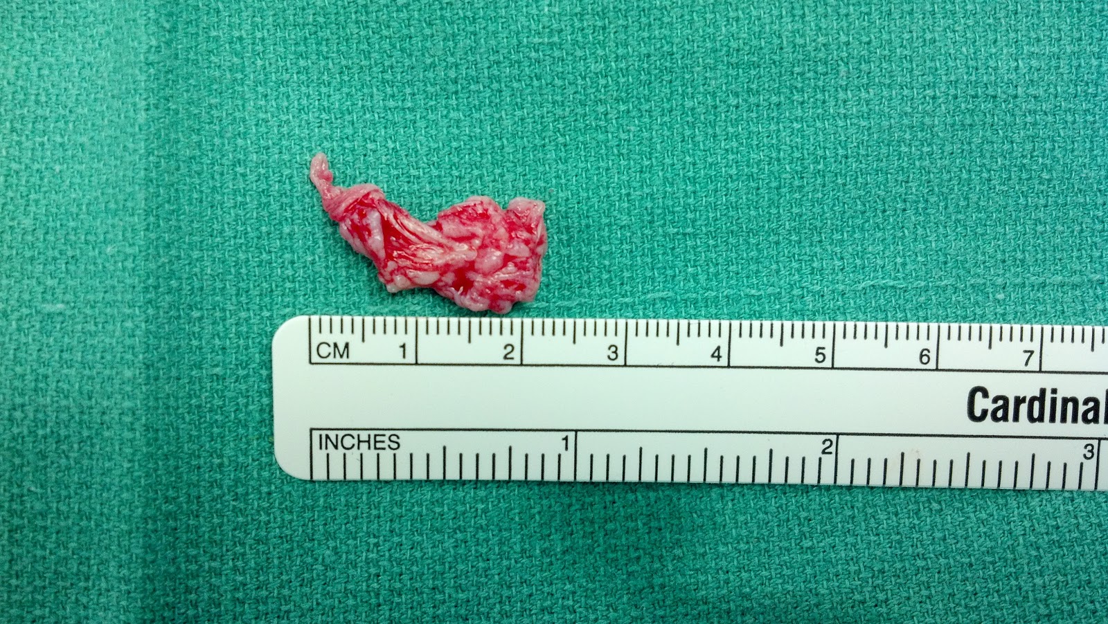 38 yo executive with huge trunk shift scoliosis caused by huge disc