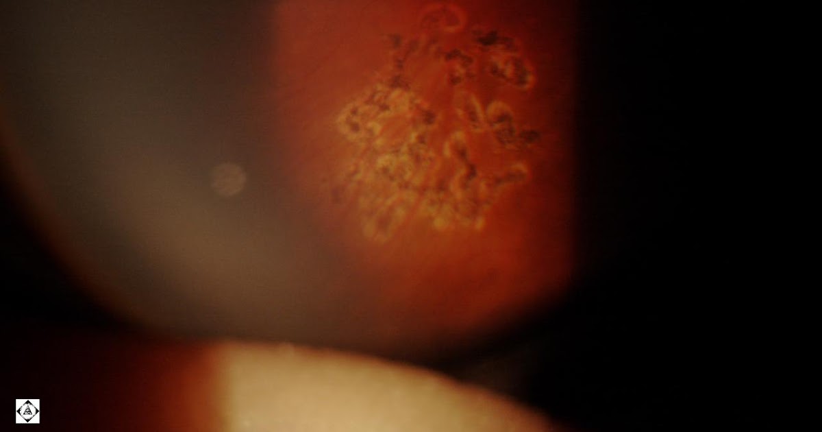 Sonoran Desert Eye Center LASER SCARS FROM A REPAIRED RETINAL HOLE