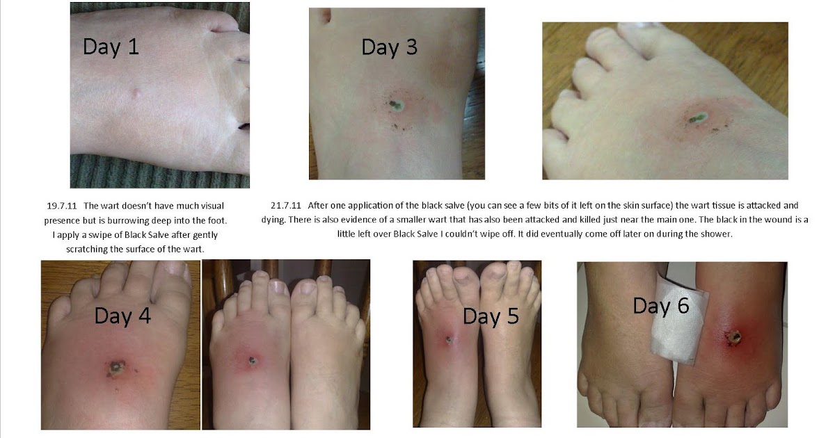 Holistic Therapy Connections Treatment of a Plantar Wart