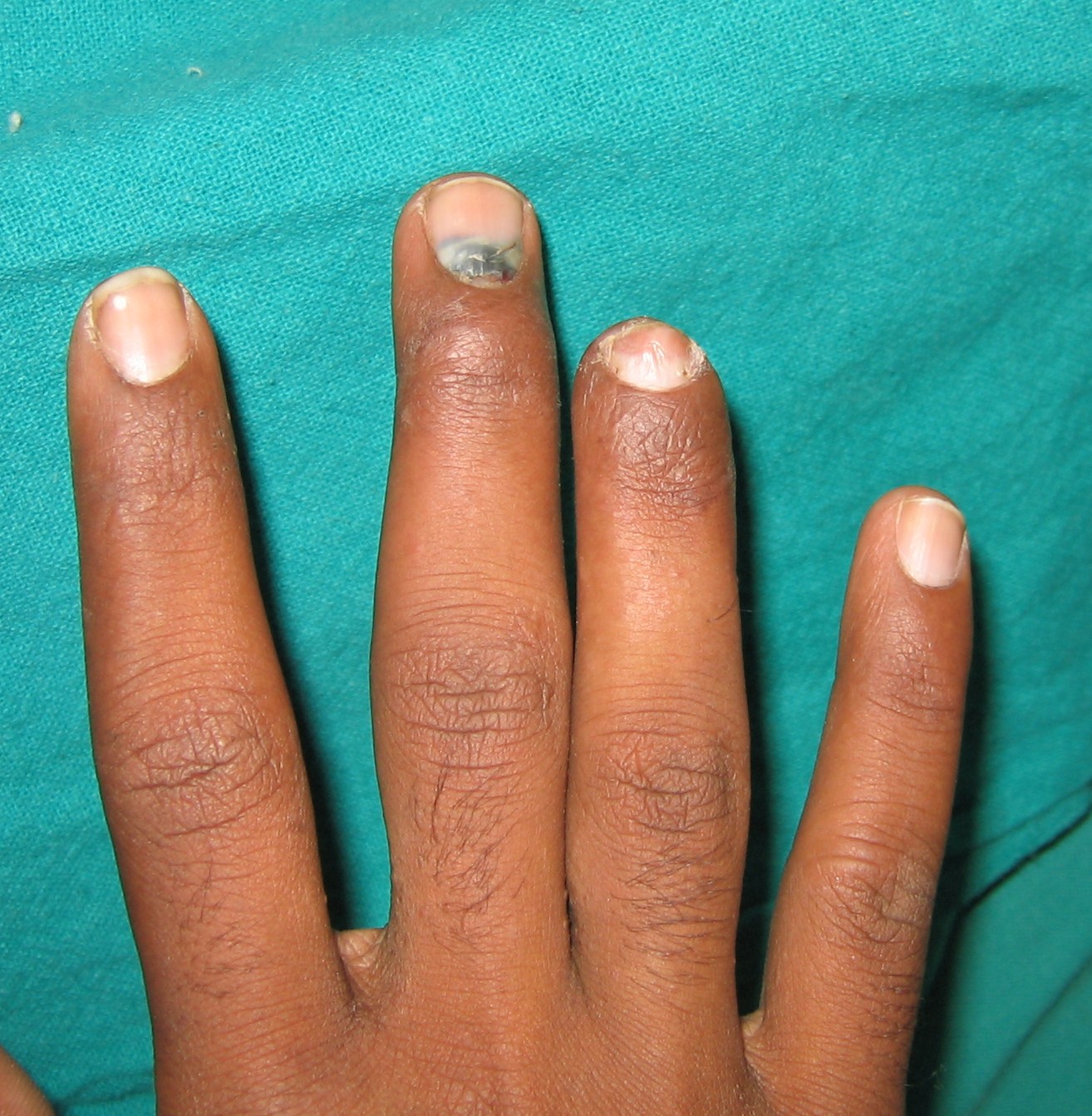 CRUSH INJURIES OF HAND AND UPPER LIMB INJURIES HAND TRAUMA FINGER TIP INJURY IPSILATERAL