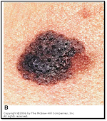 MELANOMA CUTANEO