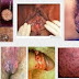 Apakah kutil Kelamin Menular? thumbnail