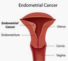 endometrial carcinoma endometrial carcinoma