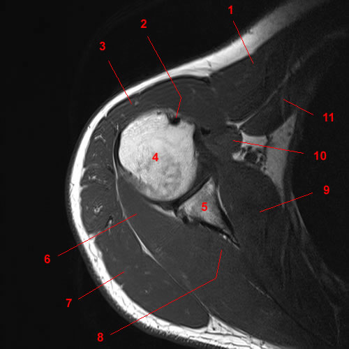 shoulder axial view mri
