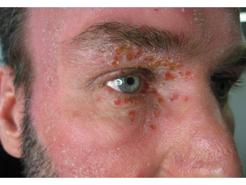 Consultations in Dermatology The Golden Crusts Impetigo