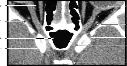 orbit ct scan