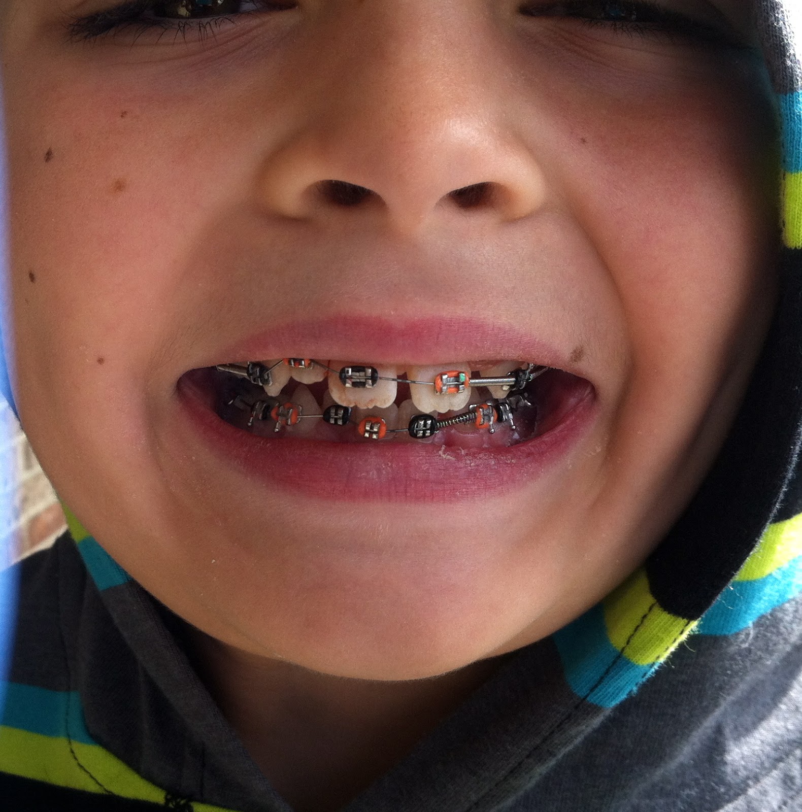 List 102+ Pictures Pictures Of Stained Teeth After Braces Completed