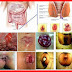 Obat Benjolan Luar Ambeyen thumbnail