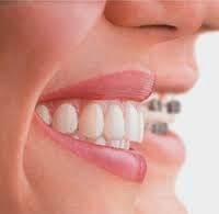 http://www.citydentalaurangabad.com/orthodontics-treatments-lingual-orthodontics.php#invisalign-technique