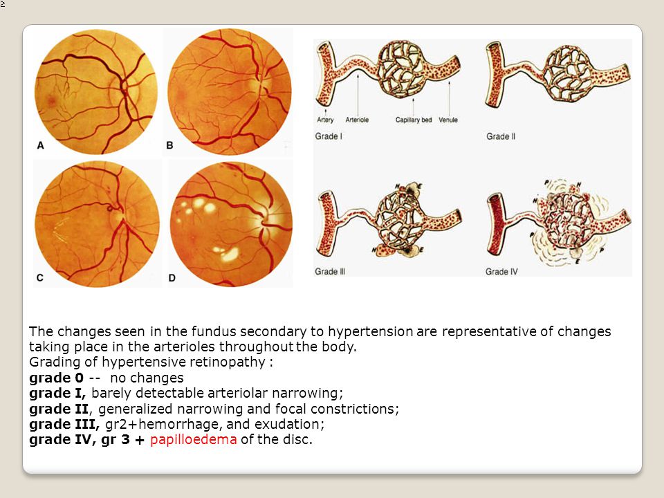 Retinopathy Stages Of Hypertensive Retinopathy My XXX Hot Girl