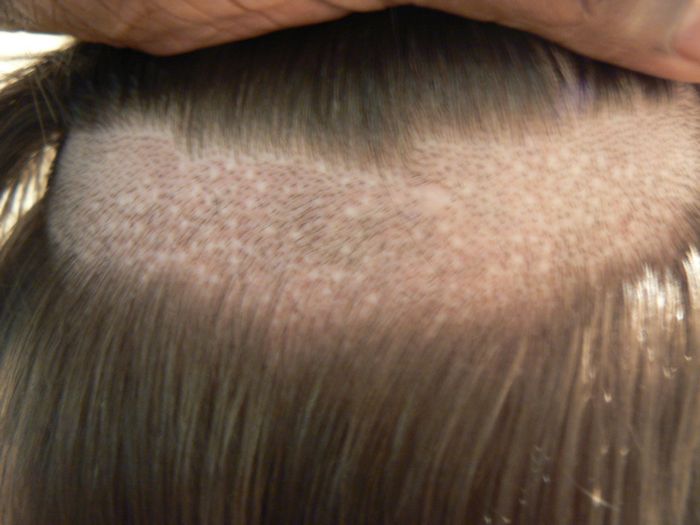 Dr Bisanga Haartransplantationsarzt Bhr Clinic In Brussel Meine Donor Fotos Vergleich Fue Mit Strip Narbe