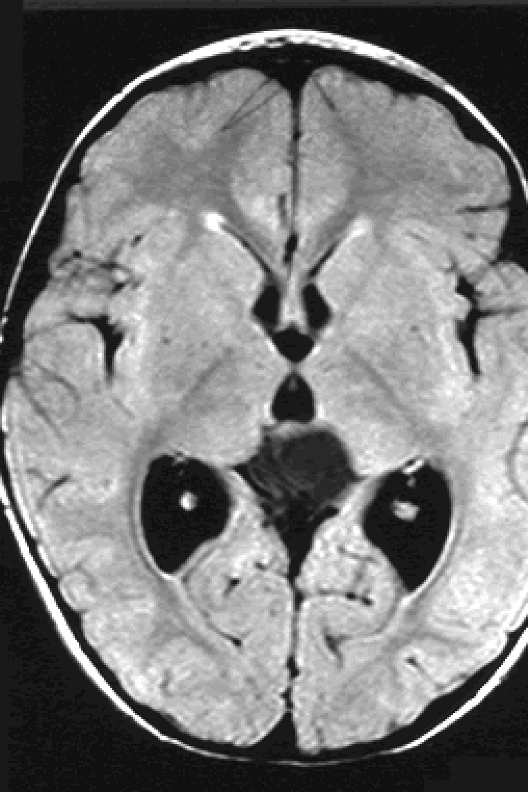 Normal+brain+ct+scan+images