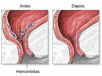 Hemorroidas Fotos