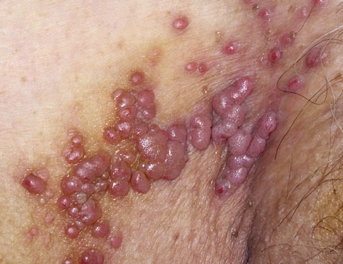Penyakit Herpes Pada Kelamin