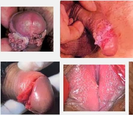 Obat Herbal Penyakit Kutil Kelamin Obat Herbal Penyakit Kutil Kelamin
