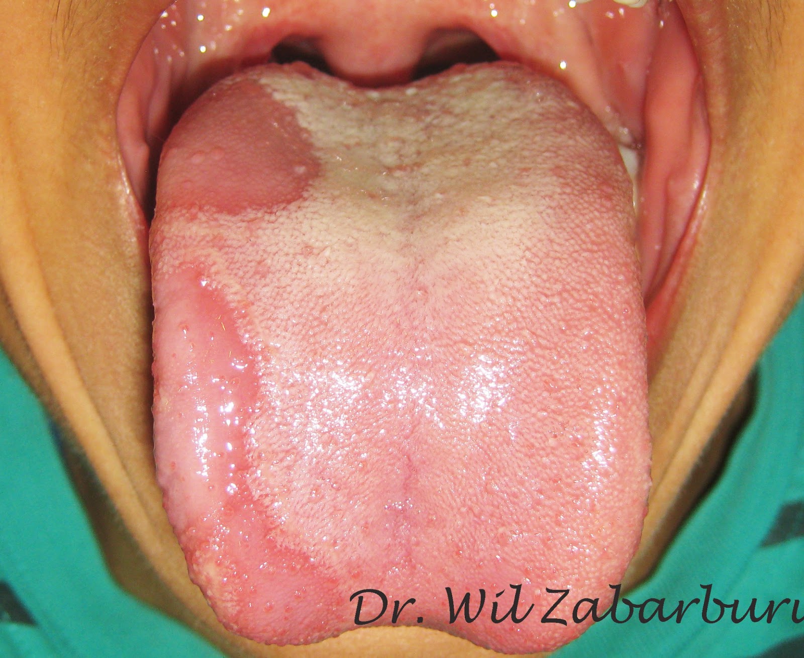 Lengua+Con+Grietas Lengua Geografica http://clinicadentalasistencial.blogspot.com/2013_01 ...