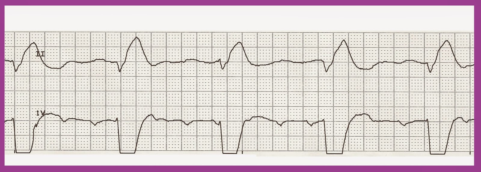 Practice EKG Strips 417