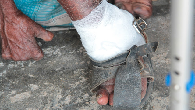 Modern Day Mother Theresa's - Showing God's Love at the Leper's Medical Clinic 2 Lepers002