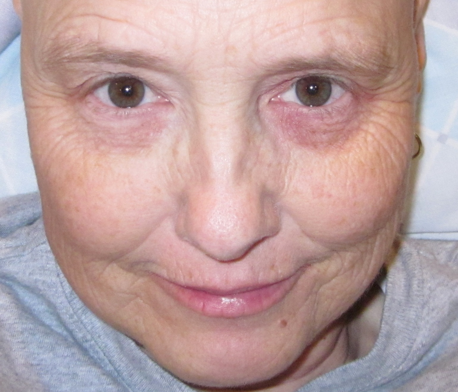 jm's Adventure with Multiple Myeloma Last outpatient Velcade/Decadron