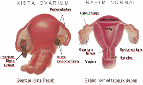 cara mengobati kista ovarium cara mengobati kista ovarium, cara mengobati penyakit kista, cara mengobati kista, cara mengobati penyakit kista pada wanita