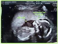 18 week ultrasound