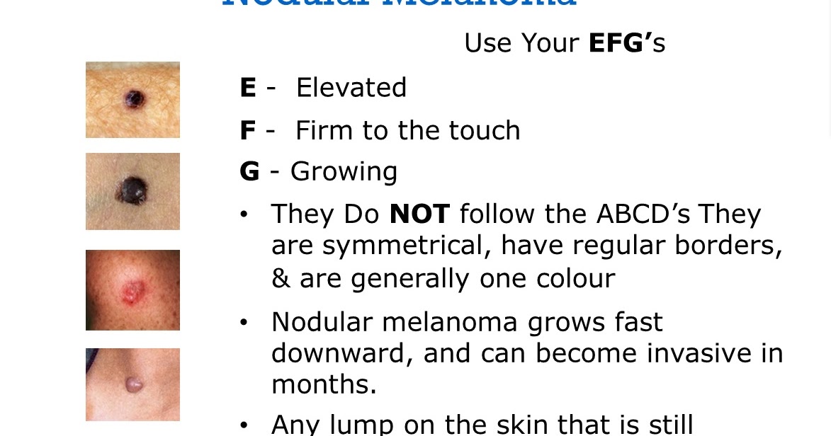 Mission "Melanoma" Nodular Melanoma