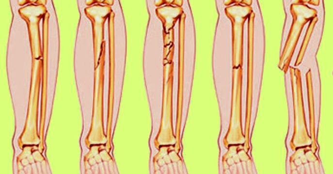 Pengertian dan jenis jenis patah tulang Ddayip dokumen