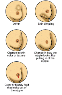 Early signs of breast cancer