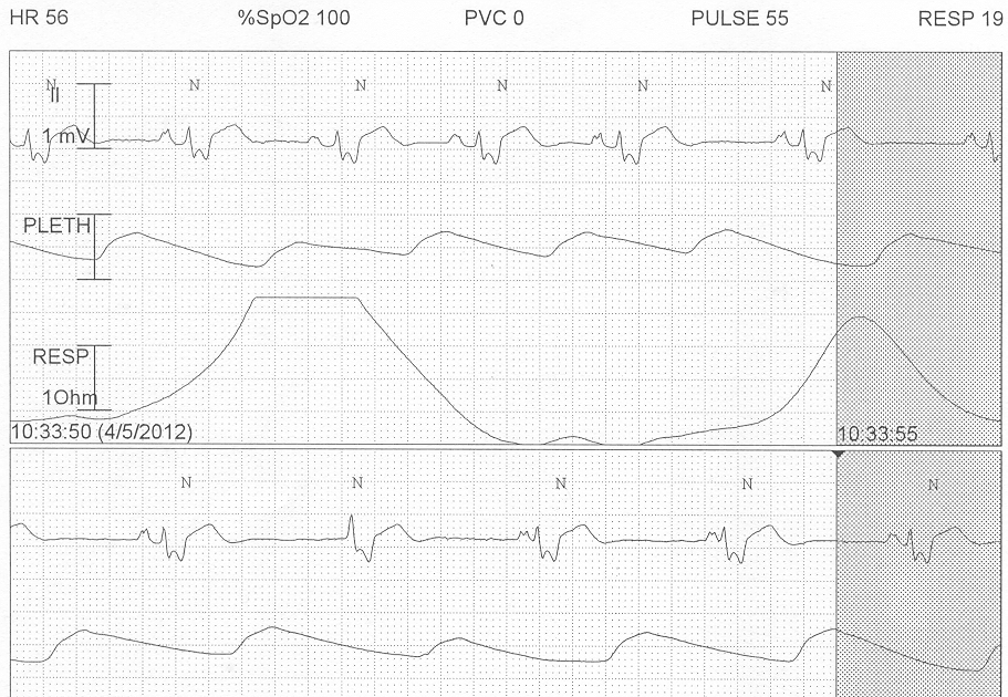 Pedi cardiology EKG Sinus bradycardia with Junctional Escape
