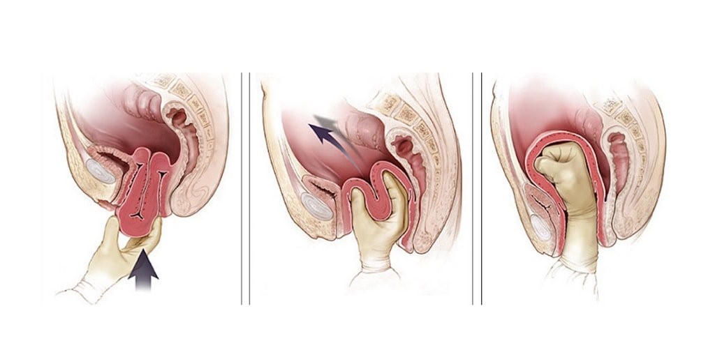 Влагалище После Первого Секса