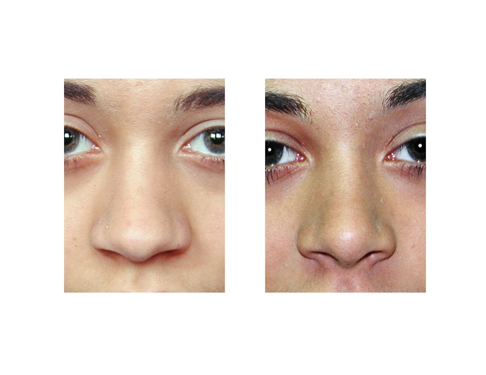 Broken Owen Wilsons. .errr. .uh. .Noses ENT Health