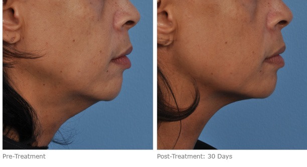 Dr Ht Ile Genclesmek Ameliyatsiz Yuz Germe Ultherapy