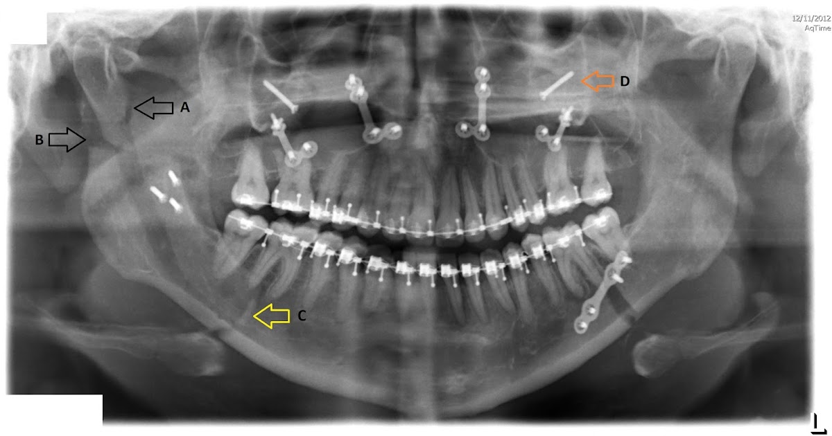 Double jaw surgery with a bit of hip thrown in! : Day 49: Seven Weeks