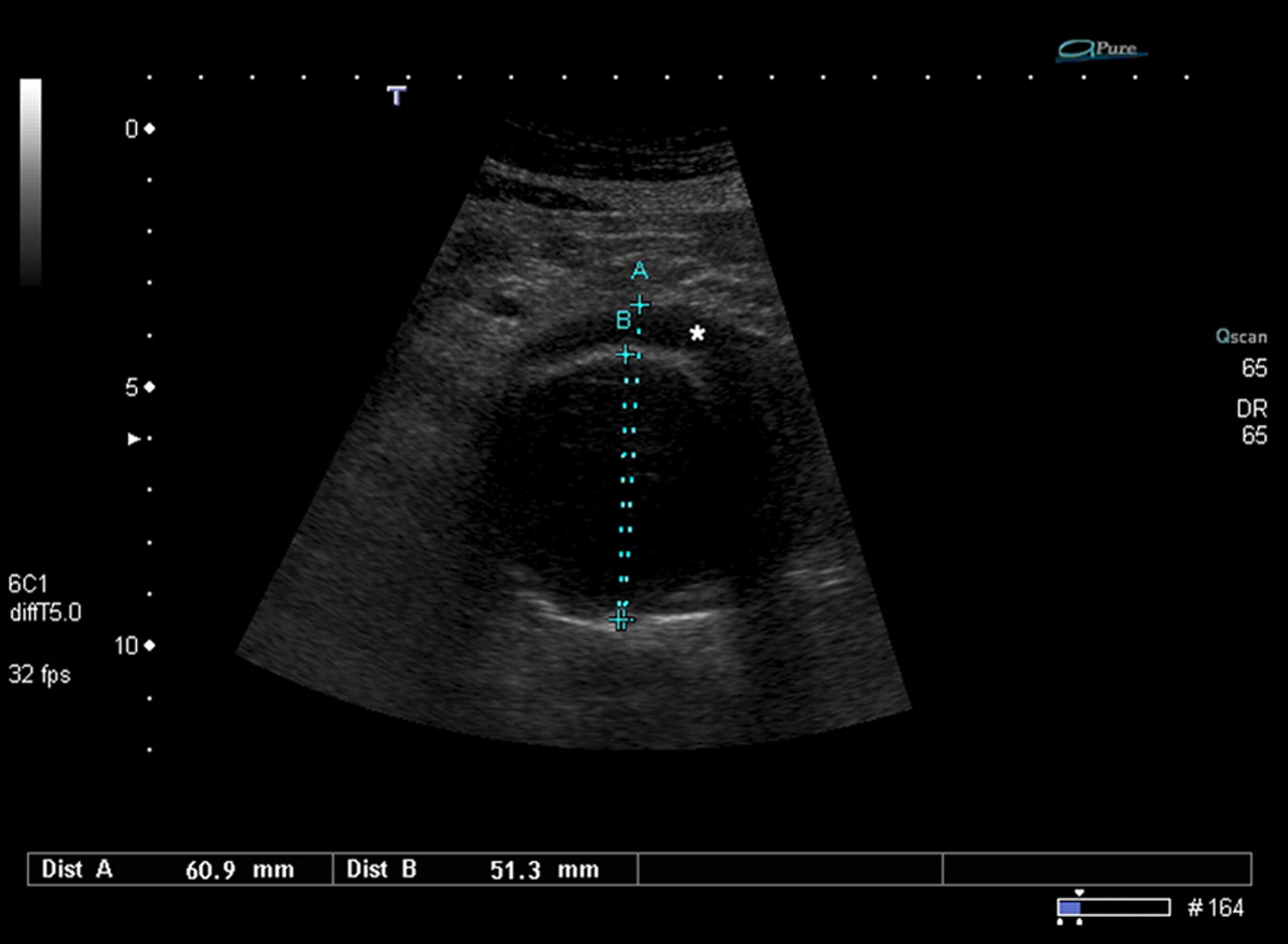 Sonographers Blog: Ultrasound Screening
