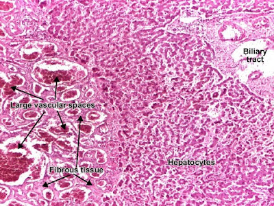 Histology and explanation of Cavernous hemangioma liver