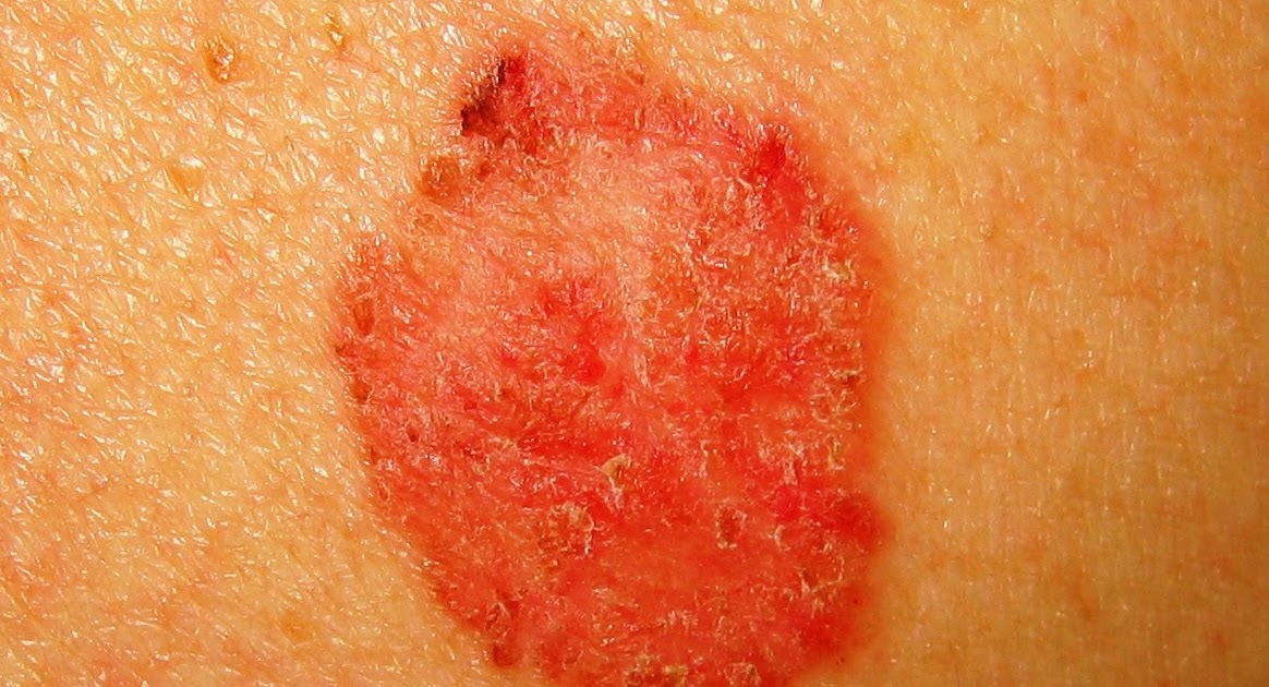 Squamous Cell Carcinoma Warning Signs And Images The vrogue.co