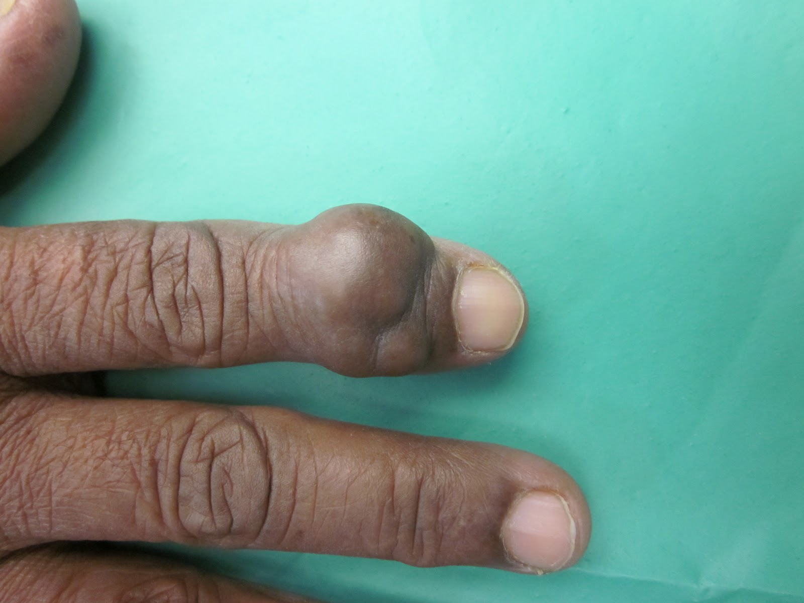 Tumor On Finger