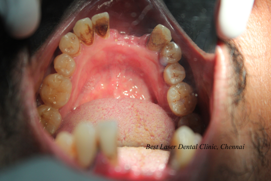 Lower Front Tooth Replacement using dental implants
