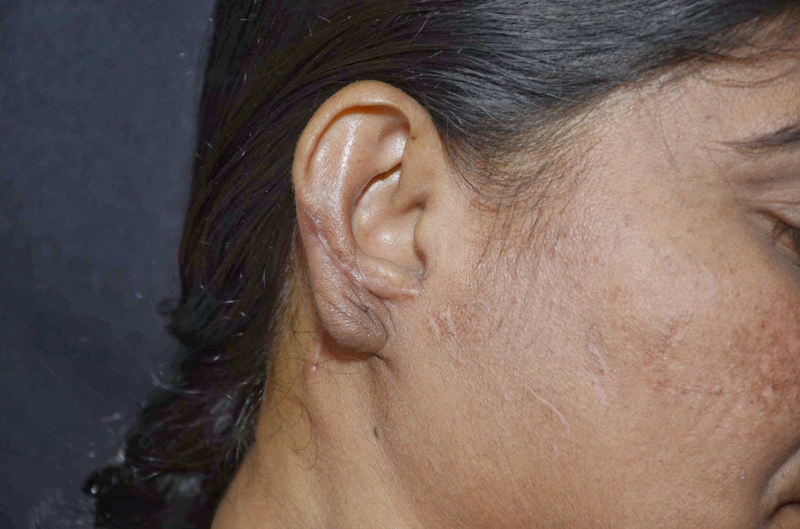 DOG BITE TOTAL EAR LOBE LOSS PLUS HELIX PARTIAL LOSS AURICULO