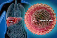 Cara Mengobati Penyakit Hepatitis B Secara Tradisional Cara Mengobati Penyakit Hepatitis B Secara Tradisional
