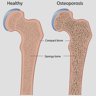 a look at the causes symptoms and treatment of osteoporosis Osteoporosis is a condition in which bone tissue breaks down osteoarthritis comprehensive overview covers symptoms causes and treatment of heres a look. a look at the causes symptoms and treatment of osteoporosis Osteoporosis is a condition in which bone tissue breaks down osteoarthritis comprehensive overview covers symptoms causes and treatment of heres a look.