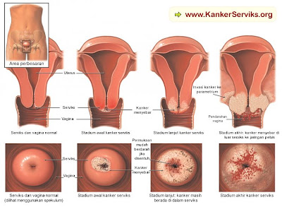 Proses kanker serviks