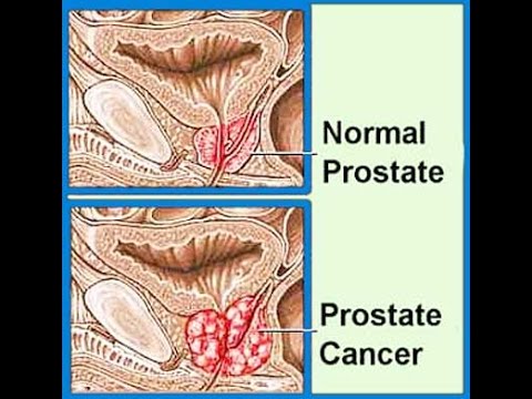 Prostate cancer avodart therapy Prostate cancer avodart therapy