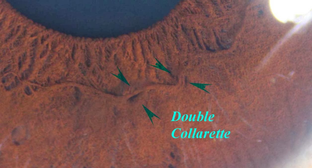 Modern & Multidimensional Iridology IPB, Pupillary Zone, Collarette