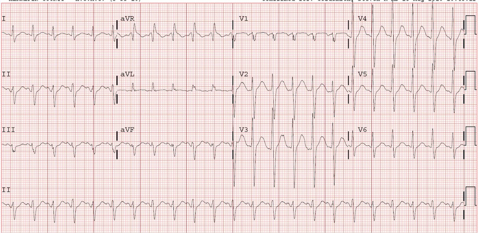 terminal r wave