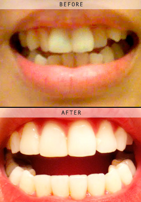 braces colors that make your teeth look white braces colors that make your teeth look white