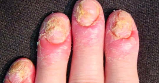 El ungüento yiganerjing de la psoriasis el precio