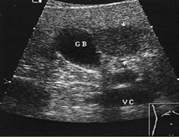 MBBS Medicine (Humanity First): Liver Ultrasound