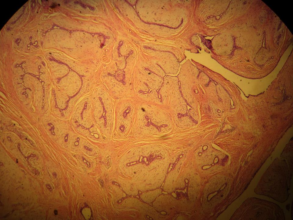 Hyalinized fibroadenoma pathology image