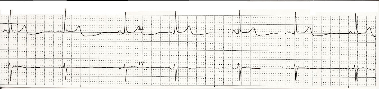 Bigeminy Ekg